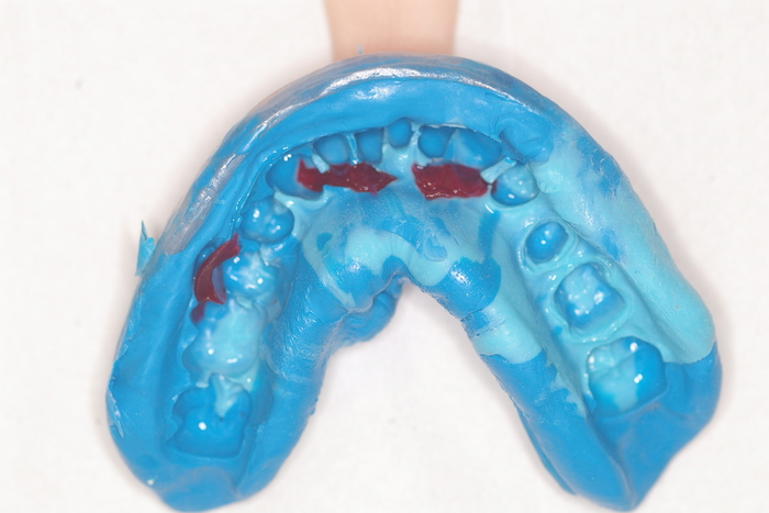 クラウンを作製するための型採り_b0190560_16365180.jpg