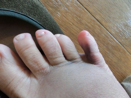 まさか 足の小指が骨折 田舎暮らしのケセラセラ１
