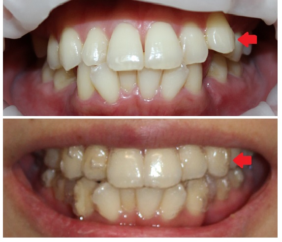 インビザライン歯列矯正　（透明マウスピースによる歯列矯正）_d0092965_23541651.jpg
