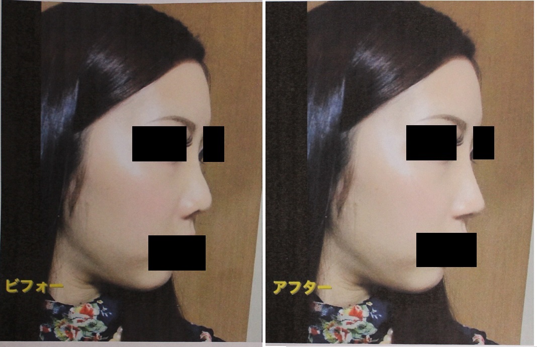 三度目の鼻中隔延長術（他院鼻中隔延長術修正術）、小鼻縮小術、小鼻肉厚減幅術、鼻プロテーゼ入れ替え　2_d0092965_1285680.jpg