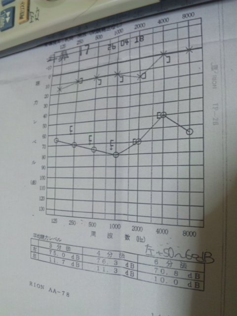 突発性難聴のタイムライン_a0134136_041912.jpg