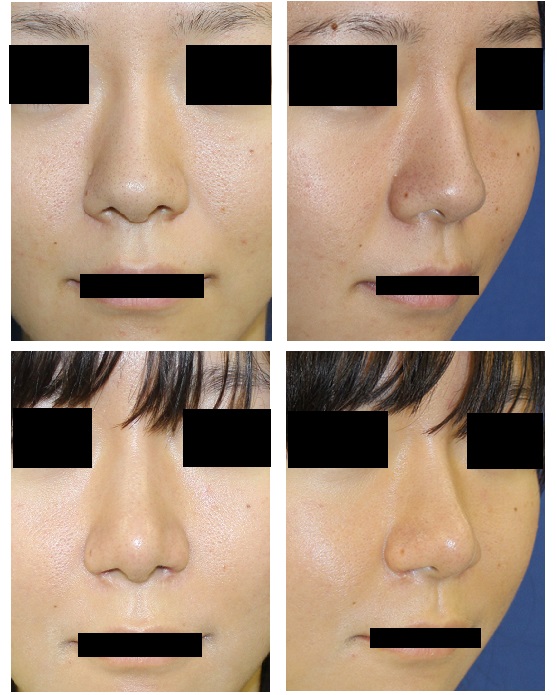 鼻尖縮小（クローズ法）、小鼻肉厚減幅術、法令線プロテーゼ_d0092965_2465537.jpg