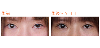 二重 埋没法 右 術後3ヶ月目 dr勝間田のブログ 二重 埋没法 右 術後3ヶ月目 dr勝間田のブログ