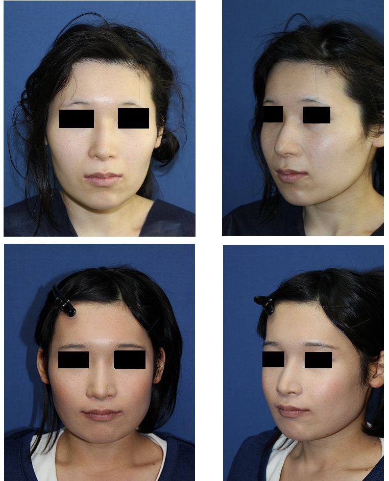 中顔面短縮術＜ルフォー　（Le Fort） I 型骨切術　、下顎矢状分割術（SSM）＞、頬骨骨切術_d0092965_3401244.jpg