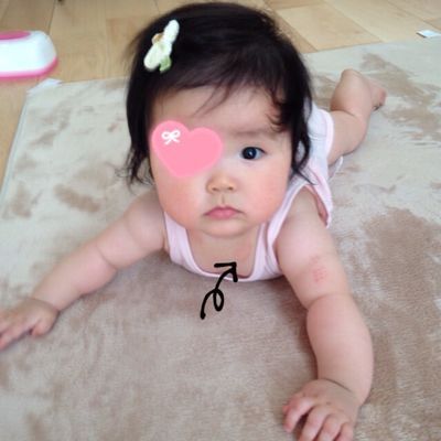 キスマーク うちの赤ちゃん