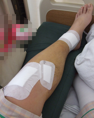 脛骨 腓骨 骨折記 バイク事故 その5 風とバイクと俺と 脛骨 腓骨 骨折記 バイク事故 その5 風とバイクと俺と