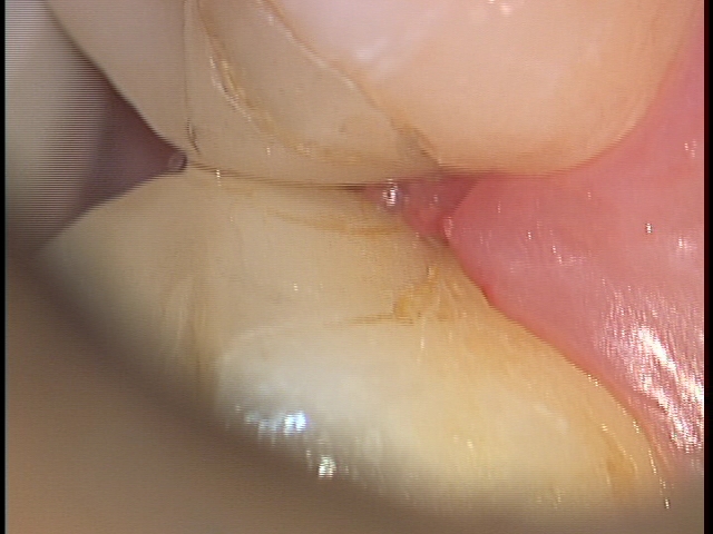 歯科医師の腕　治療後歯にフロスで挟まる取れない　東京職人歯医者_e0004468_11160401.jpg