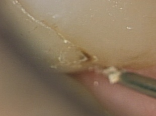 歯科医師の腕　治療後歯にフロスで挟まる取れない　東京職人歯医者_e0004468_11160422.jpg