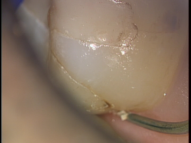歯科医師の腕　治療後歯にフロスで挟まる取れない　東京職人歯医者_e0004468_11160435.jpg