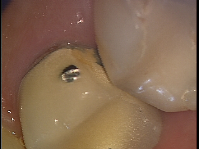 歯科医師の腕　治療後歯にフロスで挟まる取れない　東京職人歯医者_e0004468_11160449.jpg
