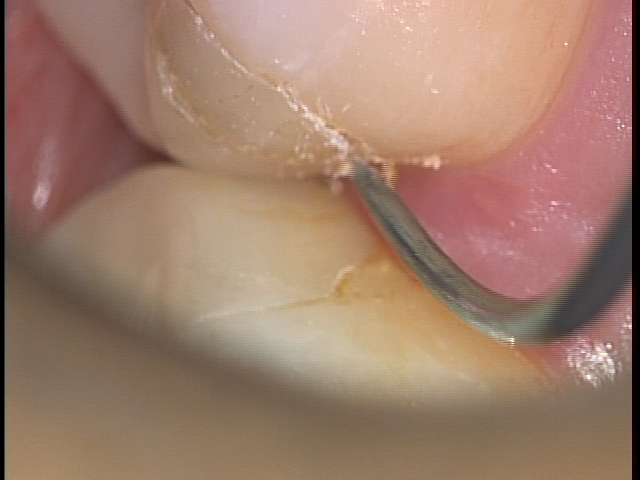 歯科医師の腕　治療後歯にフロスで挟まる取れない　東京職人歯医者_e0004468_11160462.jpg