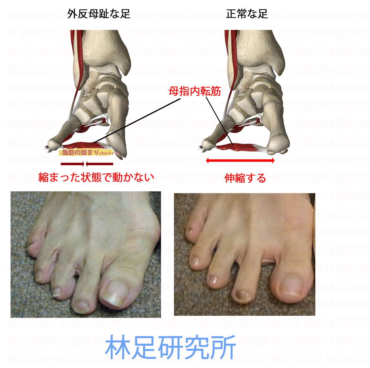 外反母趾は 骨の変形ではない テーピングは 無意味だ 手術なんて 林足研究所 足 外反母趾 修正 日常の日記