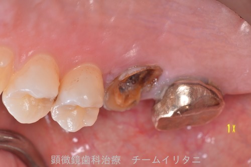 抜歯適応の歯を治療した結果　　東京職人歯医者_e0004468_14575447.jpg