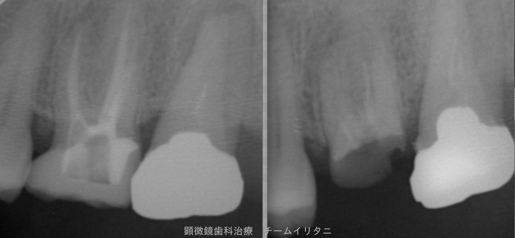 抜歯適応の歯を治療した結果　　東京職人歯医者_e0004468_14575774.png