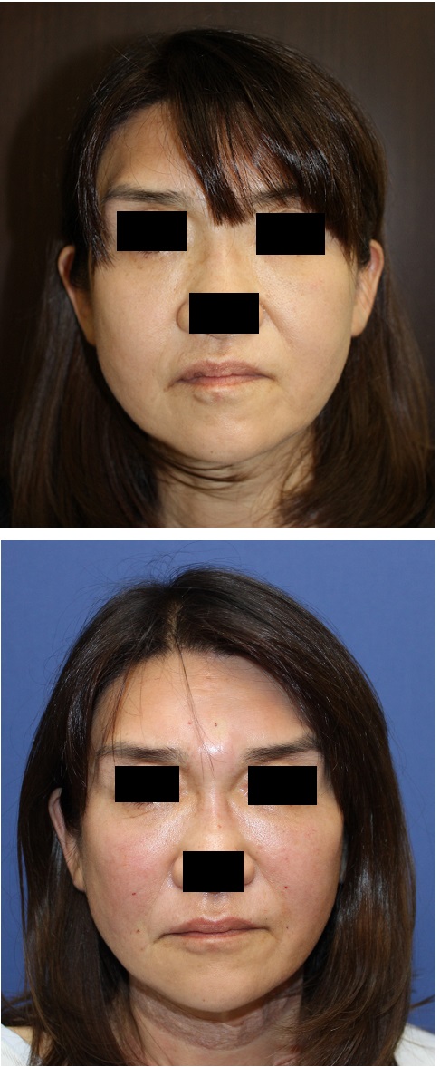 MIS(minimum invasive scaffold) 糸 とPPP(Platelet Poor Plasma)によるプチミッドフェイスリフト_d0092965_4404133.jpg