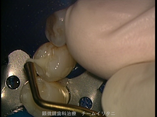 銀歯問題　削る必要があったのか疑問　東京職人歯医者_e0004468_7252083.jpg