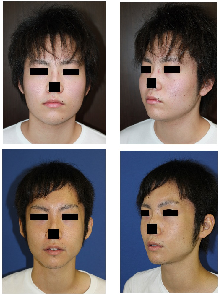 頬骨再構築　術後約３年　　、　スティック骨切術　術後約２年_d0092965_1920514.jpg