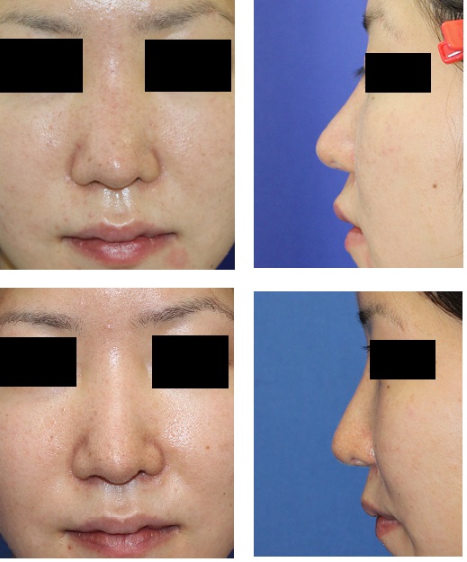 鼻ヒアルロン酸　隆鼻術　　　鼻はプロテーゼの方がヒアルロン酸隆鼻術より安全である_d0092965_23405561.jpg