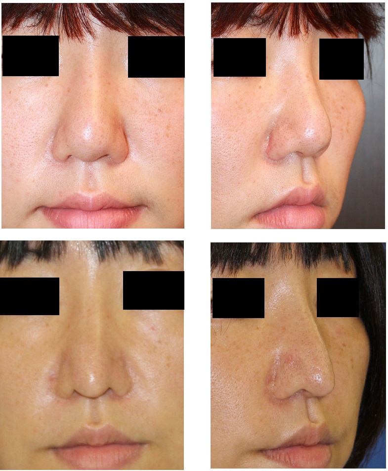 他院鼻プロテーゼ入れ替え（Ｌ型→Ｉ型）、鼻尖縮小術、鼻中隔延長術（肋軟骨）、鼻翼基部プロテーゼ_d0092965_240223.jpg