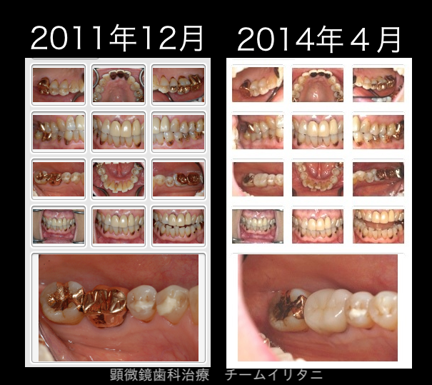 ゴールドクラウン抜歯宣告の２年後の結果　根管治療　東京顕微鏡歯科総合診療_e0004468_20465145.png