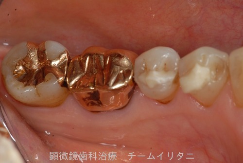 ゴールドクラウン抜歯宣告の２年後の結果　根管治療　東京顕微鏡歯科総合診療_e0004468_20471640.jpg
