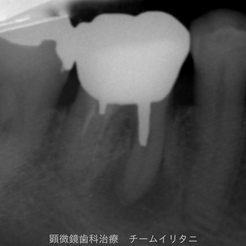 ゴールドクラウン抜歯宣告の２年後の結果　根管治療　東京顕微鏡歯科総合診療_e0004468_2047586.jpg