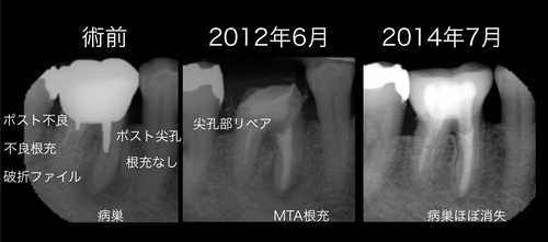 ゴールドクラウン抜歯宣告の２年後の結果　根管治療　東京顕微鏡歯科総合診療_e0004468_8361459.png