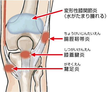 スポーツで関節を痛めた方へ　～その5～ジョギング・ウォーキング_a0296269_10035495.jpg