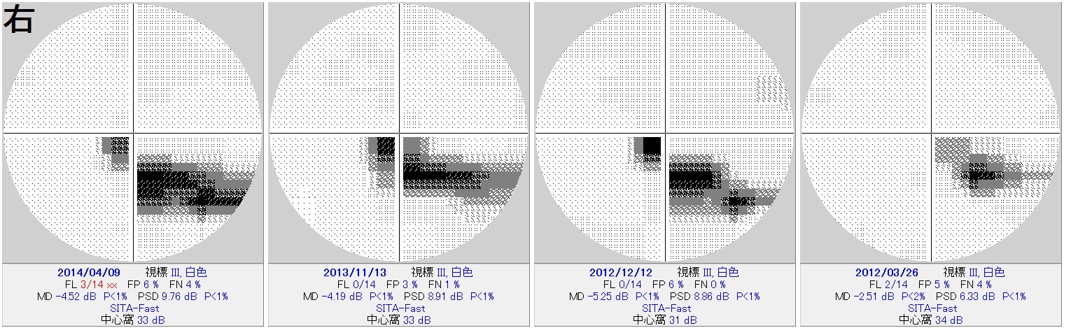 第401回大阪眼科集談会　その2　(775)     ※揺さぶられっ子症候群_f0088231_17432465.jpg