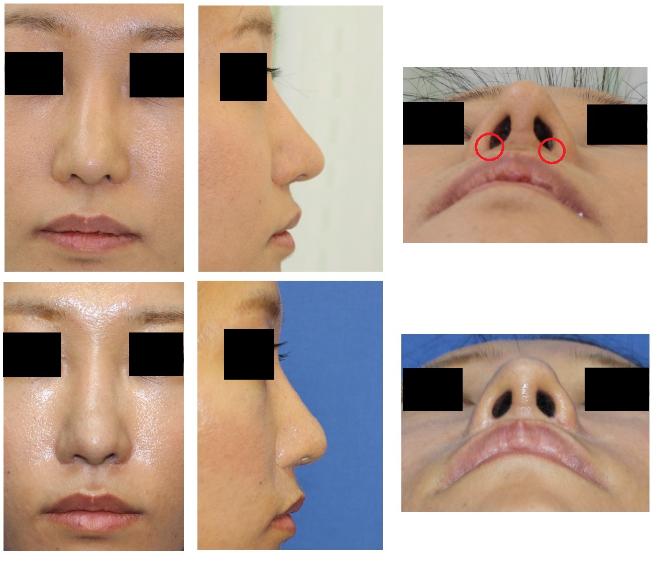 8年前に移植された鼻尖部軟骨の除去術、　鼻孔形態修正術_d0092965_16242539.jpg