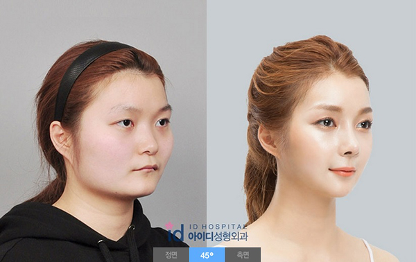 Id病院の手術前後写真 韓国美容整形 両顎手術 韓国美容整形旅行案内会社ナビ 韓国整形ブログ