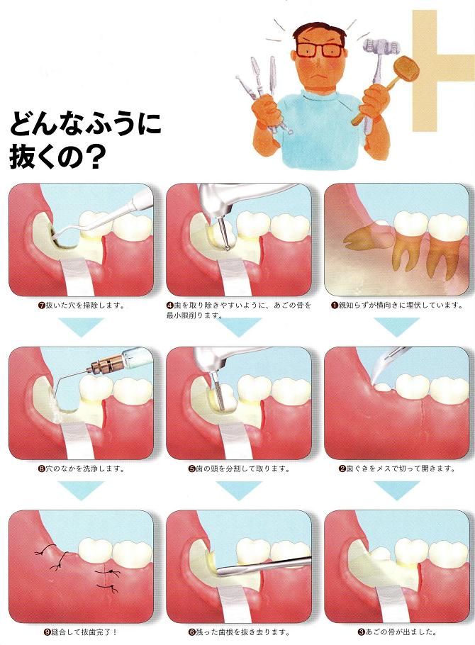 親知らずを抜いて・つるっと立ちごけ_e0197785_21502382.jpg