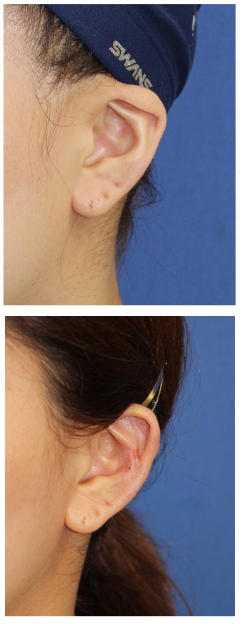 寝耳修正手術　＋　耳介形態修正術　:  折れ耳修正術_d0092965_4262399.jpg