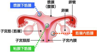 子宮筋腫とは_b0328361_1773832.jpg