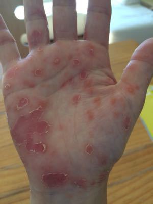 掌蹠膿疱症になっちゃった まるくておいしいよ 掌蹠膿疱症になっちゃった まるくておいしいよ