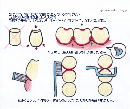 虫歯や歯周病にならない歯の磨き方_d0144726_6314481.jpg
