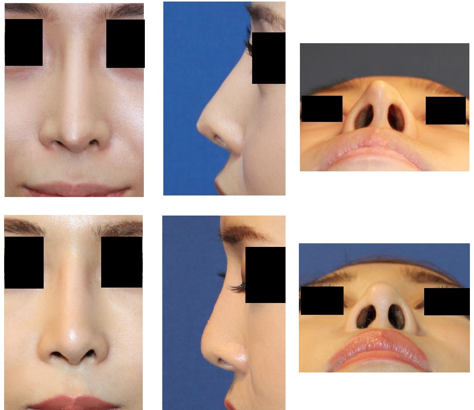 他院鼻尖部軟骨移植術術後 　婦人科組織を用いての鼻先修正術術後約３年10ヶ月_d0092965_5335241.jpg