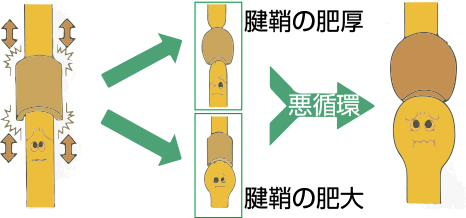 手の外科～その1 ばね指（弾発指）～_a0296269_10573494.jpg