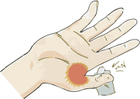 手の外科～その1 ばね指（弾発指）治療～_a0296269_10332584.jpg