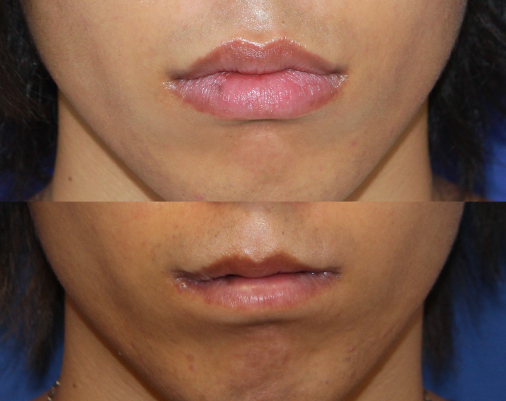 上唇 下唇を薄くする手術 術後３ヶ月 博士先生の美容外科ブログ