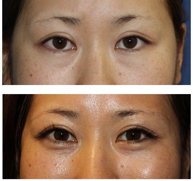 目の下のたるみ改善　：眼窩脂肪移動術（俗称　裏ハムラ）_d0092965_435935.jpg