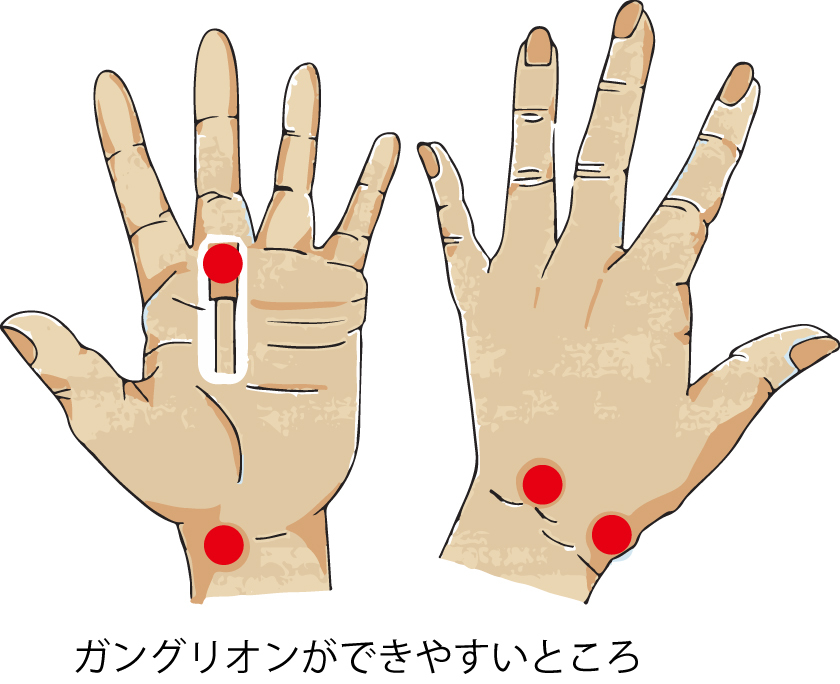 手の外科 その3 ガングリオン 弘明寺 原整形外科医院 のブログ