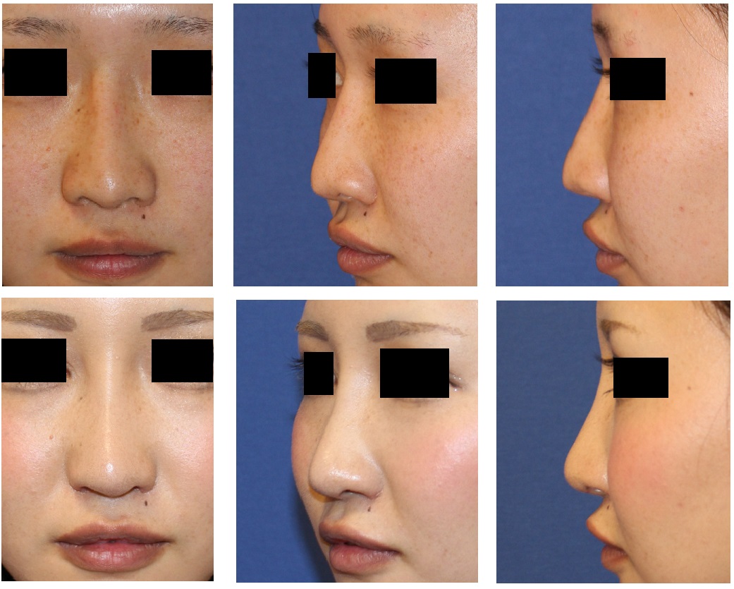 他院鼻中隔延長修正術（びっくりＬ型プロテーゼ）、小鼻肉厚減幅術、鼻根縮小術、眉間プロテーゼ　他_d0092965_1162863.jpg