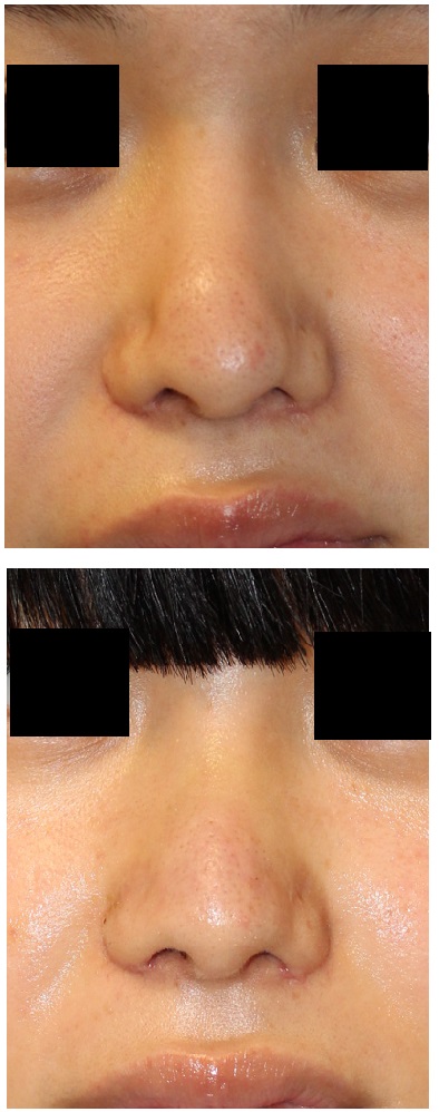 他院鼻中隔延長術後　鼻表面凹凸に対する修正術　（鼻表面デコボコ修正）_d0092965_3361051.jpg