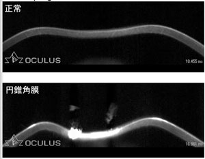 角膜の生体力学特性_a0122285_2229286.jpg