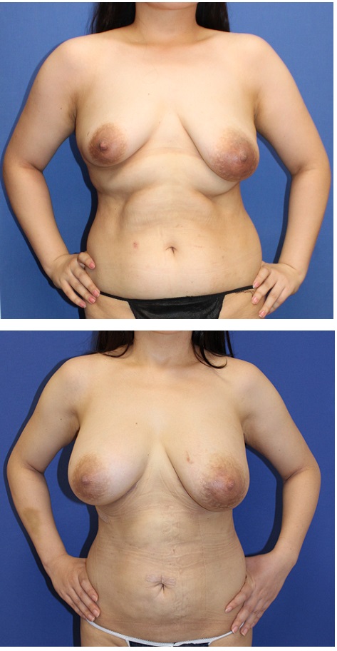 脂肪移植豊胸　　左右差のある乳房の改善_d0092965_4225685.jpg
