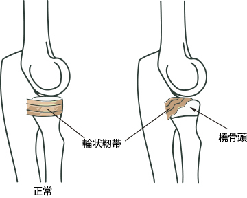 手の外科~その5~ 肘内障_a0296269_10210490.jpg