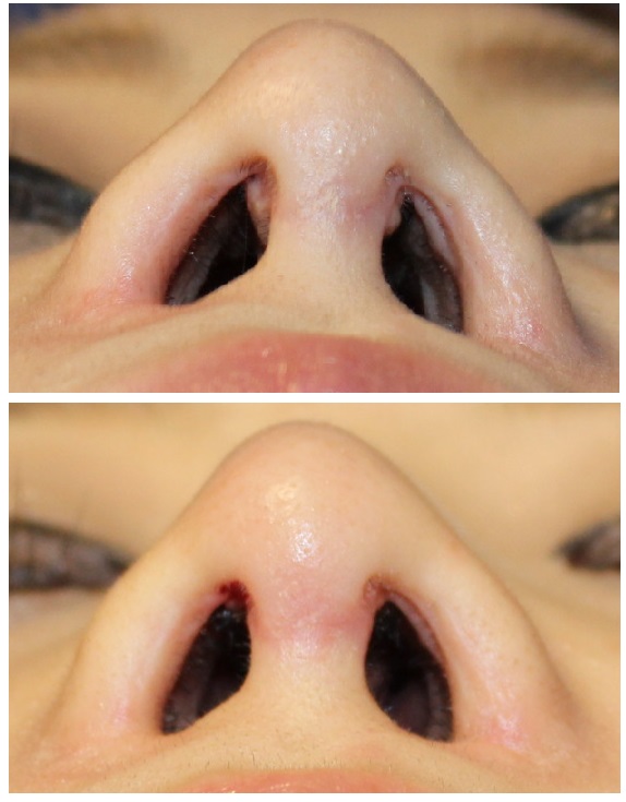 他院鼻中隔延長術後　鼻中隔部瘢痕除去手術_d0092965_2246252.jpg