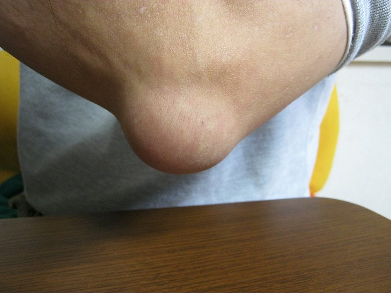 肘にぷよぷよのふくらみが たぶん滑液包炎です パソコン教室くりっくのブログ 肘にぷよぷよのふくらみが たぶん滑液包炎です パソコン教室くりっくのブログ