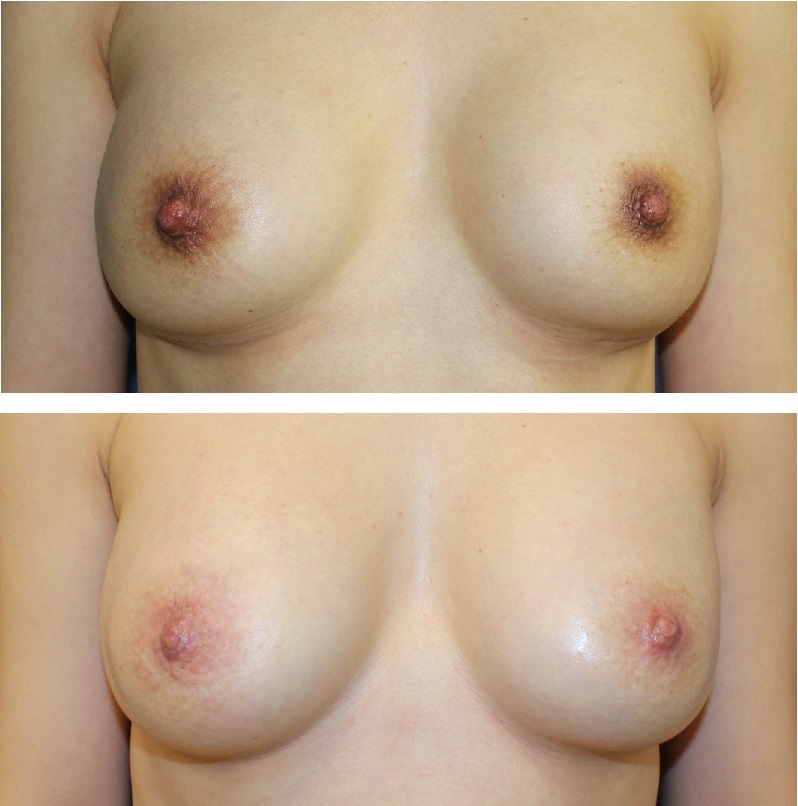乳頭縮小術（ITO法）、モントゴメリー除去術、脱色治療_d0092965_250541.jpg